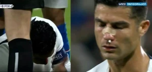 რონალდუსა და ვაცლიკის შეჯახება - პორტუგალიელმა ცხვირი დაიზიანა