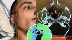 ზლატანთან შეჯახების შემდეგ ფეხბურთელს ოპერაცია სჭირდება (ვიდეო)